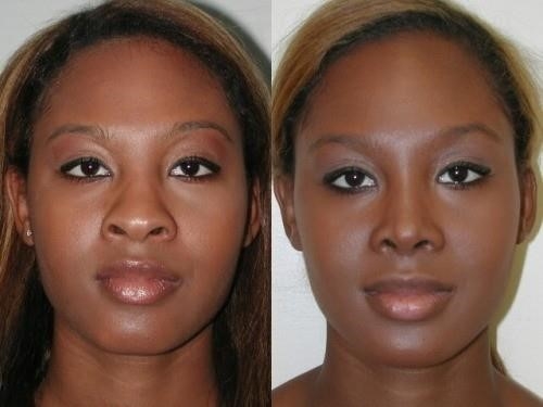 rhinoplasty experts