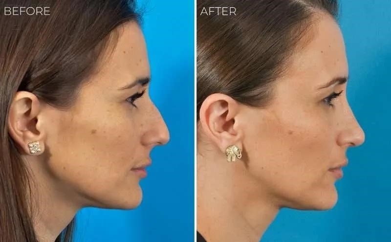 best rhinoplasty surgeons